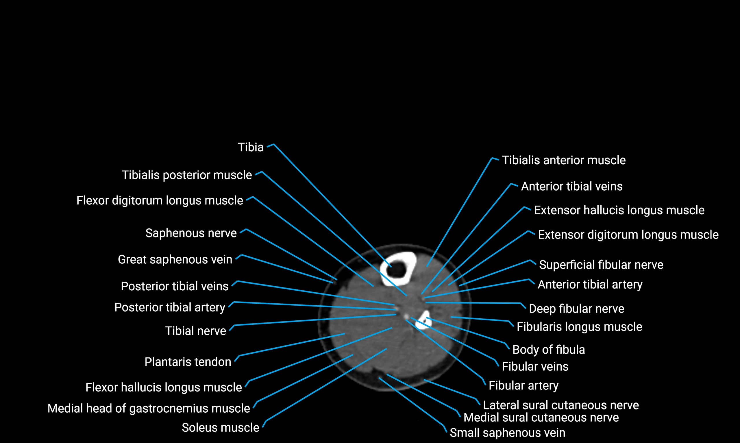 CT lower limb axial cross sectional anatomy labelled image 117 (2).webp